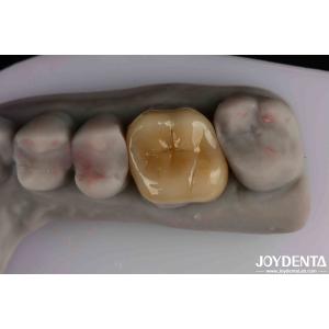 Easy To Clean And Durable Emax Inlay Onlay Resistance To Staining For Optimal