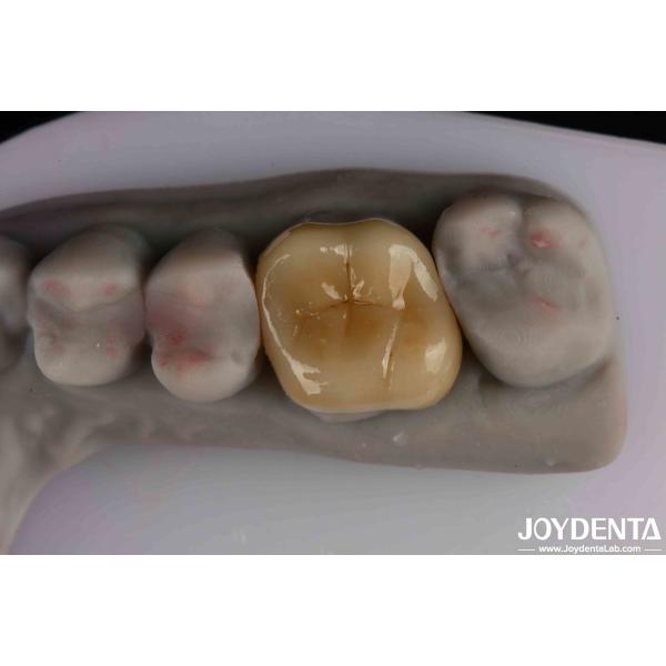 Easy To Clean And Durable Emax Inlay Onlay Resistance To Staining For Optimal