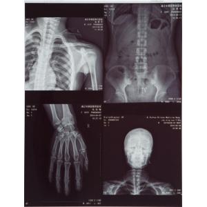 Laser Film for Medical X-ray Image Output Printing