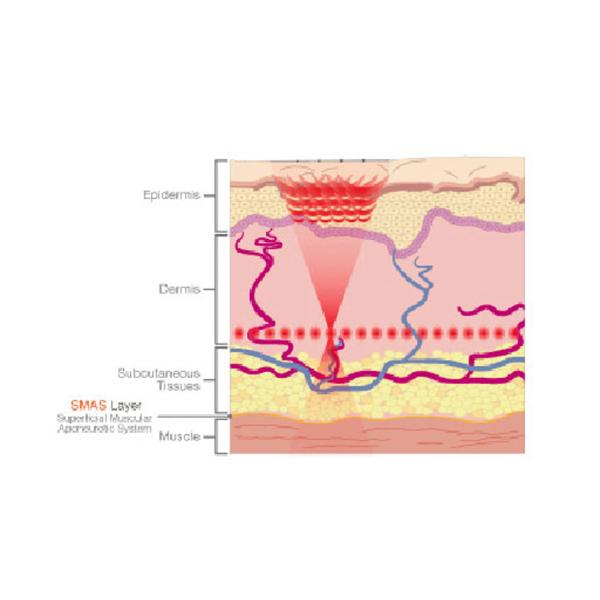 HIFU HIgh Intensity Focused Ultrasound Face Lifting Machine Body Lifting