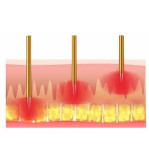 Rf Radio Frequency Skin Tightening Machine 80W High Effective For Face Lift
