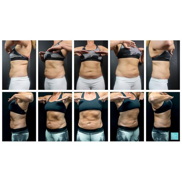 Cryotherapy Fat Burning Touchscreen Vacuum Slimming Machine