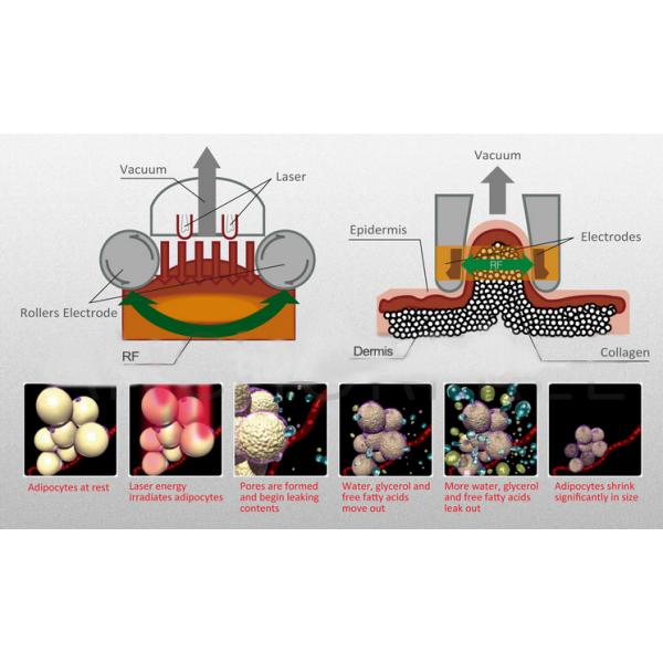 Vertical Machine Ultrasound System Device Skin Spot Treatment Slimming Equipment Weight 51kgs