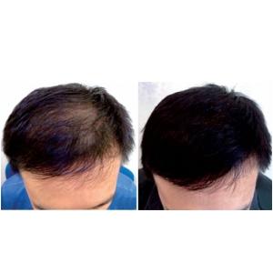 ABS 650nm Hair Regrowth Laser Cap 1360mW Anti Hair Loss 5mW