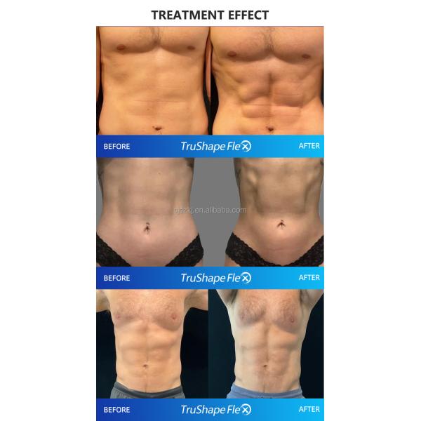 320VA Monopolar RF Machine , 4000HZ Fat Burning Slimming Machine