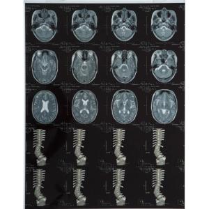 Laser Film for Medical X-ray Image Output Printing