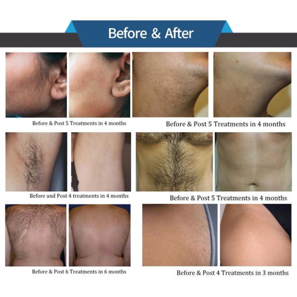 Beauty IPL Laser Radio Frequency Slimming Equipment with Drive Power 1200W