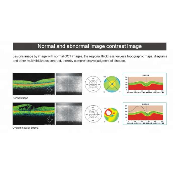 Spectral Domain OCT Optical Coherence Tomography for ophthalmology department