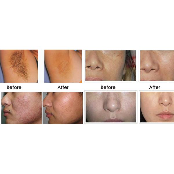 portable IPL machine for skin treatment