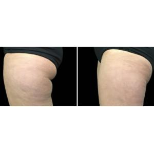 4 In 1 Lipolaser 600w 90kPa Cool Slimming Machine