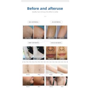 Painless 808NM diode Laser Hair Removal picosecond laserTattoo Removal Machine