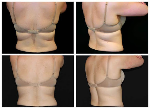 4 In 1 Lipolaser 600w 90kPa Cool Slimming Machine