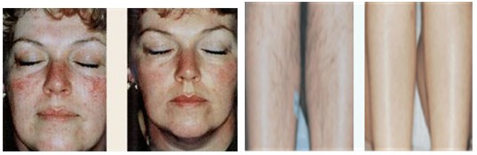 IPL 2500W RF Skin Tightening Beauty Machine Equipment with RF Power 250W