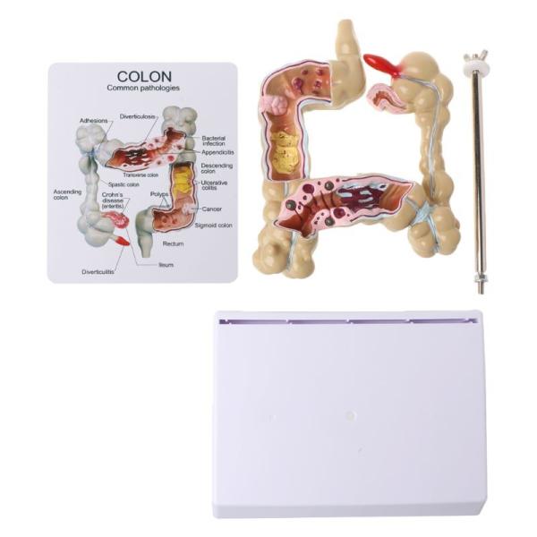Medical Teaching Pathology Colon Human Anatomy Model 22.5cm On Science