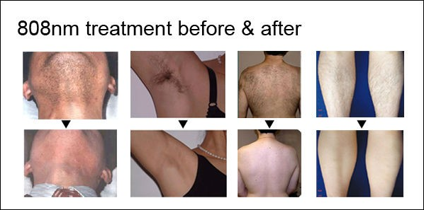 600W 1-10 Hz Alexandrite Laser Hair Removal Machines With 8" Color Touch Screen