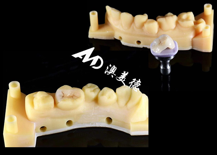 Quality Smooth Hypoallergenic Ceramic Inlays Onlays Custom Fit Stain Resistance High Durability for sale