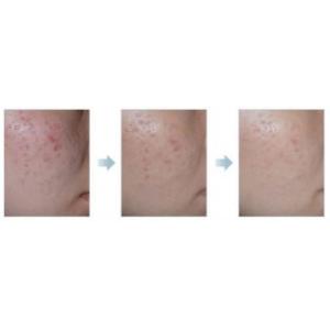 Portable No Needles Mesotharapy needle free beauty equipment machine