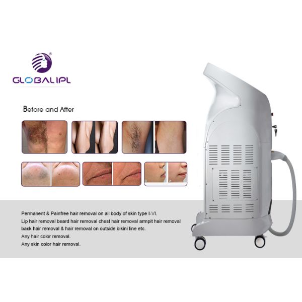 Painless Diode Laser Hair Removal Machine 5 - 400ms Pulse Width Long Lifetime