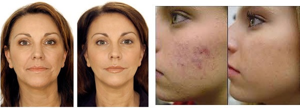 Vertical Co2 Fractional Laser Machine for pigment , stretch mark removal salon use