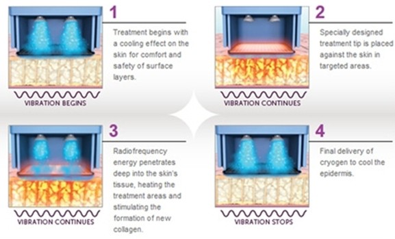 Perfect Beauty Salon Use Latest Fractional RF Micro Needle Thermal System