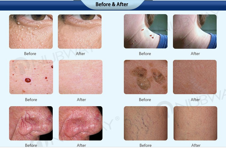 Professional High-frequency Vascular Removal Beauty Machine laser spider vein removal with CE approval