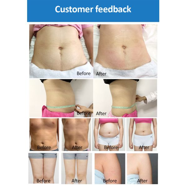 Fat Removal Non Invasive 8D Laser Therapy Machine Dual Wavelength 532nm 635nm Red And Green Light