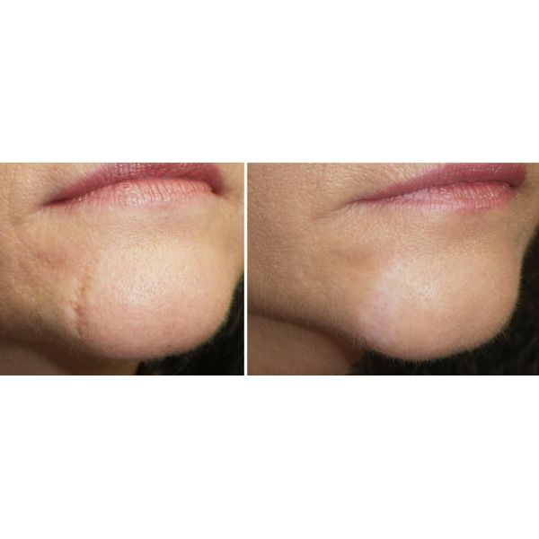 Safety CO2 Acne Scar Removal Machine , Carbon Dioxide Laser Resurfacing Machine