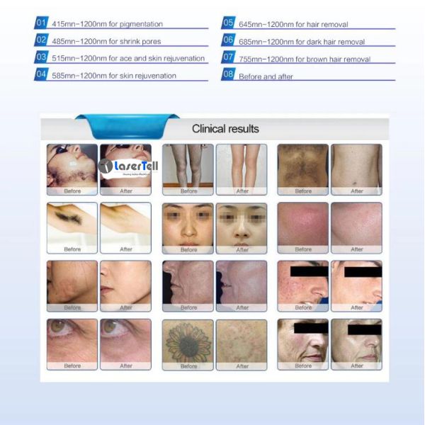 Nd Yag Laser Multifunction fat freezing machine With Intelligent Operating System