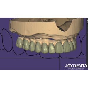 Quality Individualized Design Digital Diagnostic Wax Up Lab Software Seamless Integration for sale