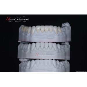 Transparent and smooth porcelain veneer