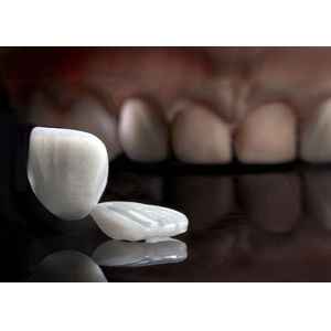 Translucency Porcelain Emax Veneer for Excellent Fit / Natural Esthetics