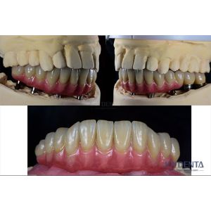 China Dental Reconstruction Multiple Teeth Implant Titanium Prosthetic Connection Internal on sale