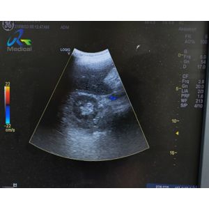 GE 4C-RS Convex Probe Ultrasound Transducer Lens Replacement