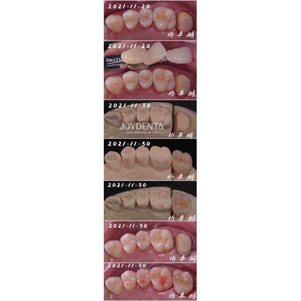 Buy Seamless Fit Porcelain Inlay Dental Procedure Customizable Shape For Teeth Repair at wholesale prices
