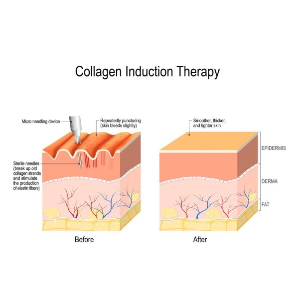 Microneedling - DermaGlam Clinic