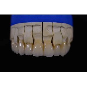 China Denture Fabrication Lab Achieving Perfectly White Dentures with Zirconia Repair on sale