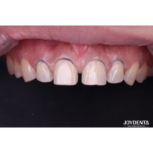 Real Looking Dental Porcelain Veneers Perfectly Fit Ceramic Teeth Veneers For