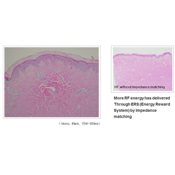 Wellness center Fractional RF Microneedle Acne Scar Removal Beauty Machine