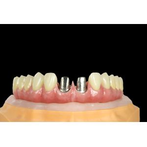 FDA Titanium Bridge Dental Implant Titanium Framework With Crown