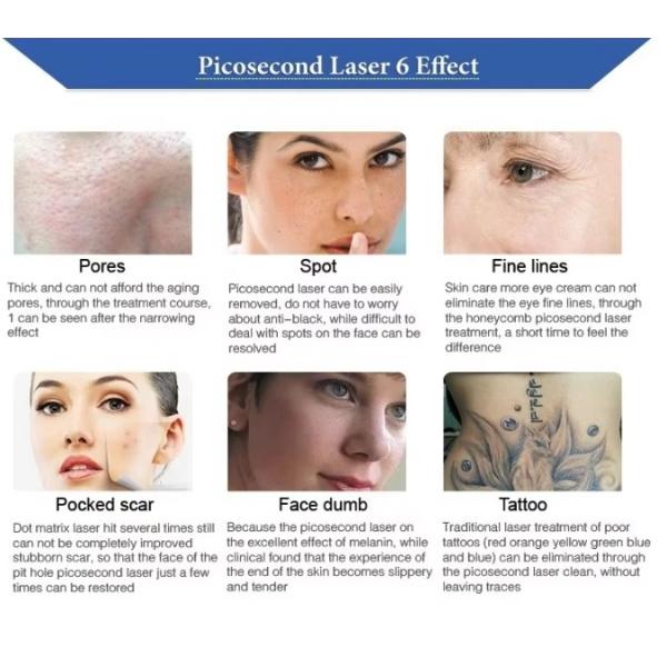 Tattoo Removal Machine Carbon Peeling Beauty Machine Picosecond Nd Yag Pico Laser Skin Equipment for Skin Whitening