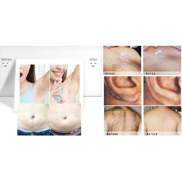 10hz Lasertell Triple Wave Diode Laser Hair Removal