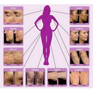 Most Popular CE Approved fractional microneedle rf for Acne Scars removal