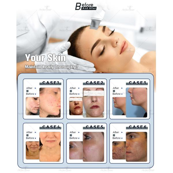 13 In 1 Water Oxygen Jet Peel Machine 250VA Hydrafacial Dermabrasion Device