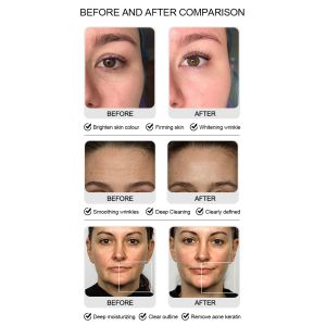 Commercial 9 in1 Oxygen Hydrafacial Machine , 90Kpa Skin Spa Machine