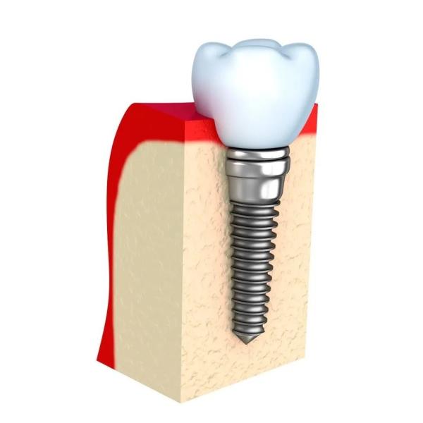 Buy Dentures Temporary Dental Implant Bar Single All Ceramic Teeth at wholesale prices