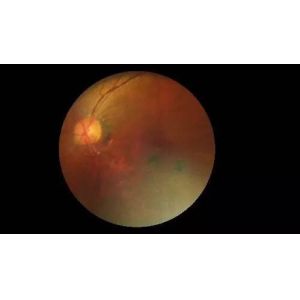 Portable Handheld Wifi Digital Ophthalmoscope For Eye Fundus