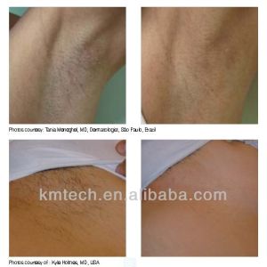 Professional Clinic Laser Hair Removal Machine Diode 3 waves KM960D
