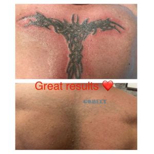 1064nm Picosecond Laser Machine Tattoo Removal With Adjustable Spots Size Heads