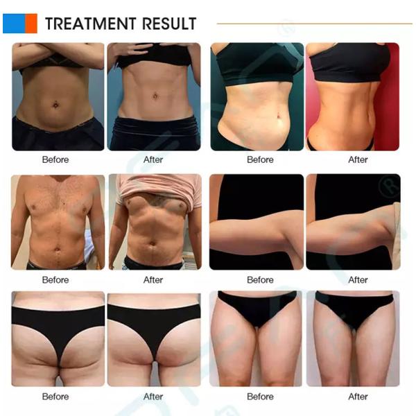 Electromagnetic Electric Muscle Stimulator Machine Fat Reduction Body Fitness 3000W