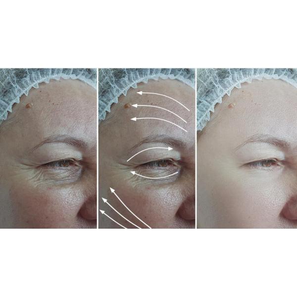 Skinject Hyaluronic Acid Dermal Filler For Lips Buttock Enlargement